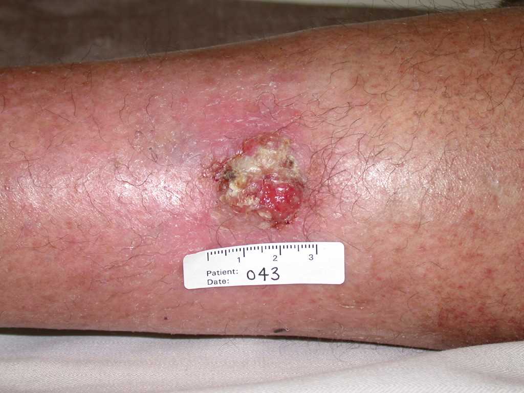 <p>Cutaneous Squamous Cell Carcinoma