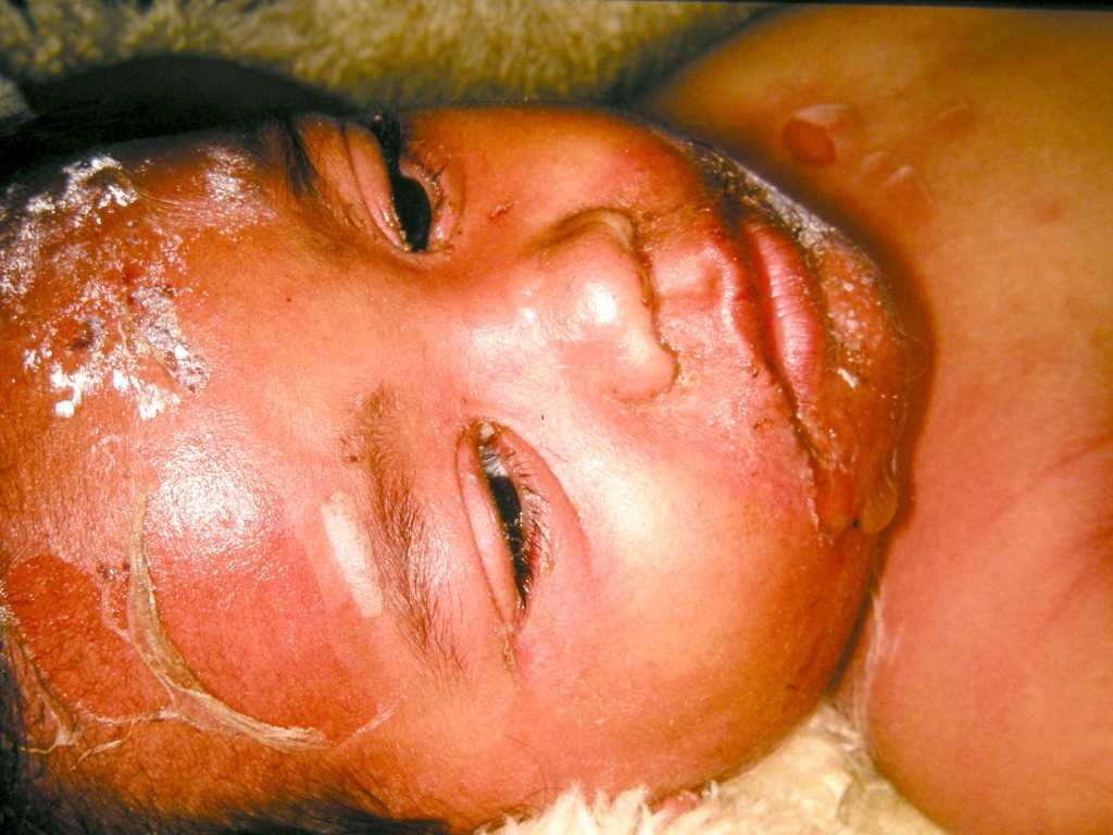 <p>Staphylococcal Scalded Skin Syndrome