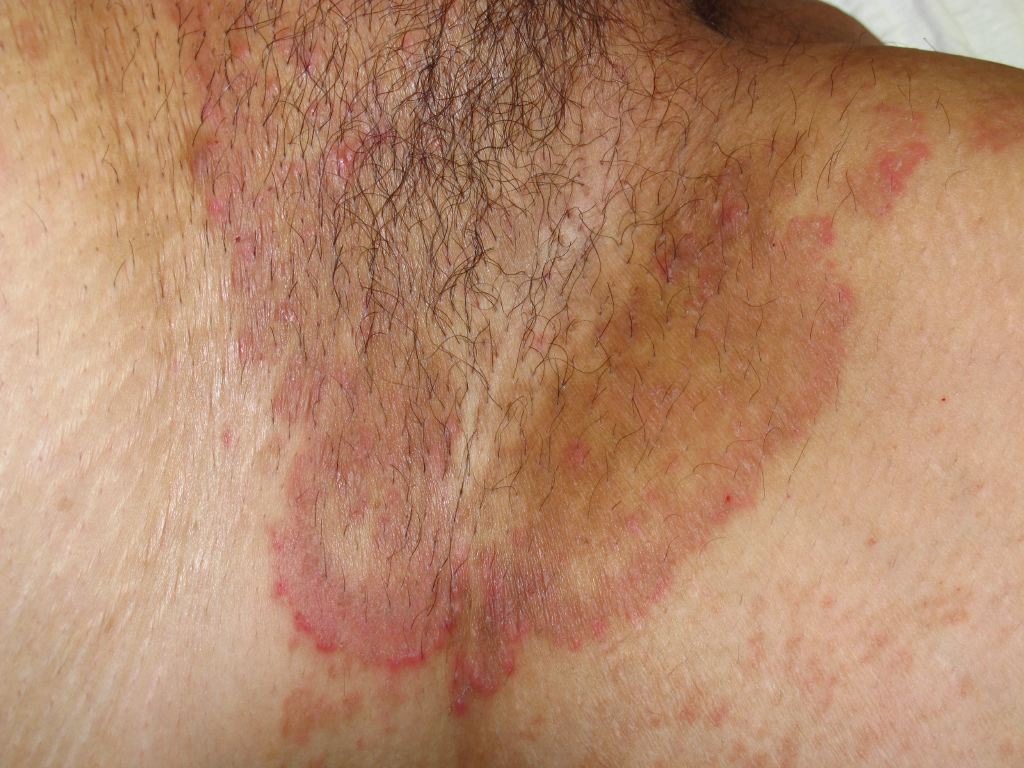 <p>Tinea Cruris</p>