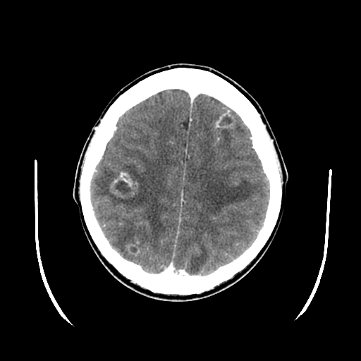 <p>Multiple Brain Abscesses. Axial CT brain with contrast abscesses noted.</p>