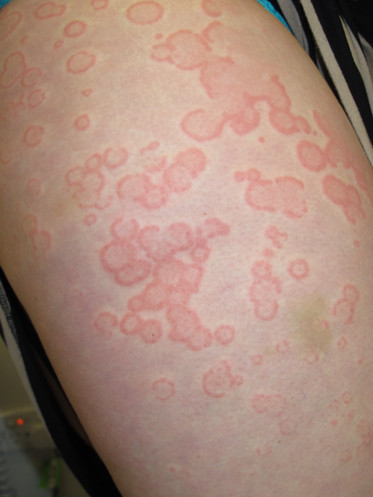 <p>Urticaria, Upper Arm</p>