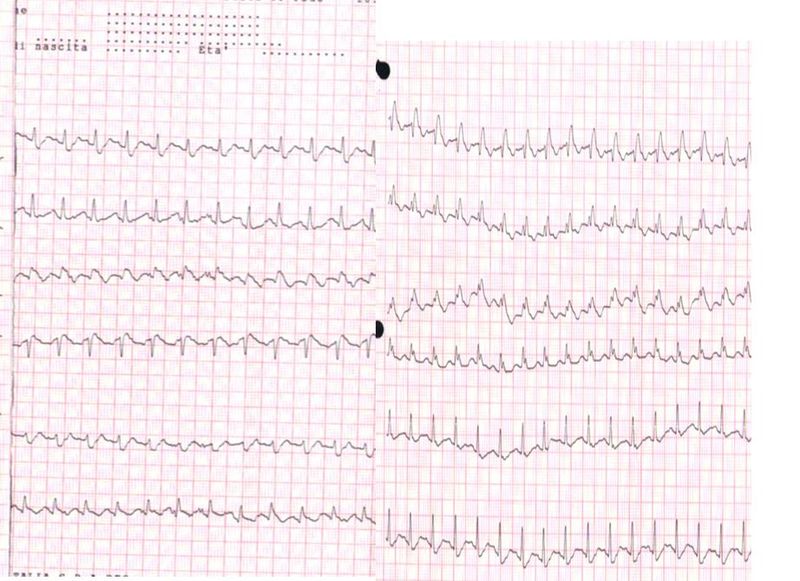 <p>Electrocardiogram,&nbsp; Pulmonary Embolism