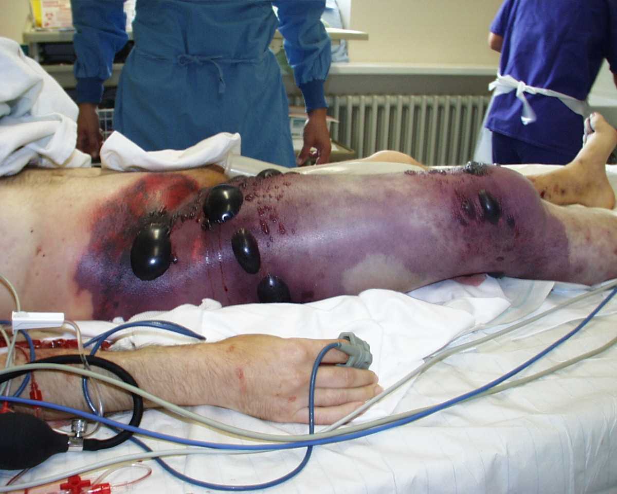  Gas gangrene of the right leg and pelvis, showing swelling and discoloration of the right thigh, bullae, and palpable crepitus. The patient, in shock at the time this photograph was taken, underwent a hemipelvectomy and died less than eight hours later.