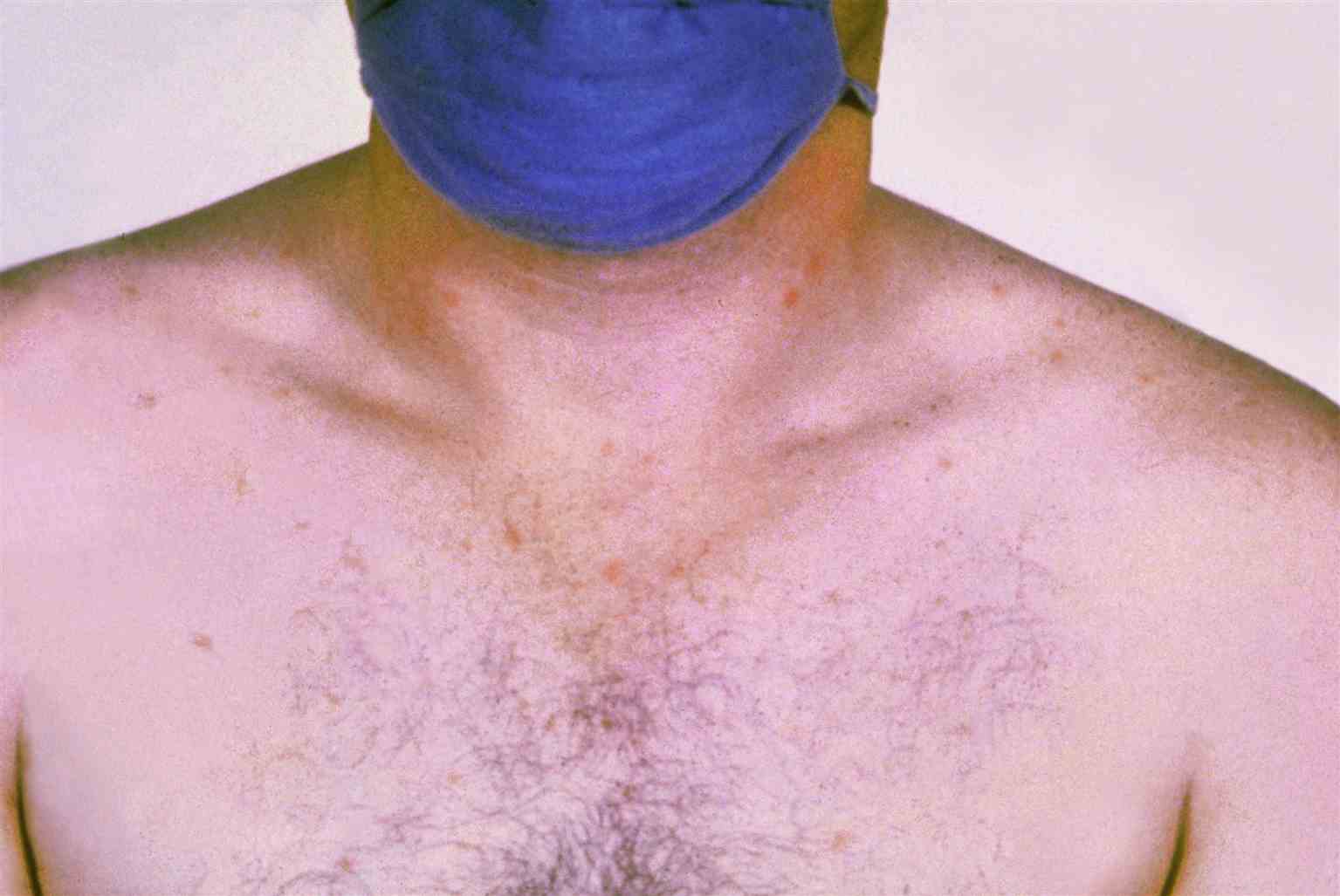 Rose spots on the chest of a patient with typhoid fever due to the bacterium Salmonella typhi. Symptoms of typhoid fever may include a sustained fever as high as 103 to 104 F (39 to 40 C), weakness, stomach pains, headache, loss of appetite. In some cases, patients have a rash of flat, rose-colored spots.