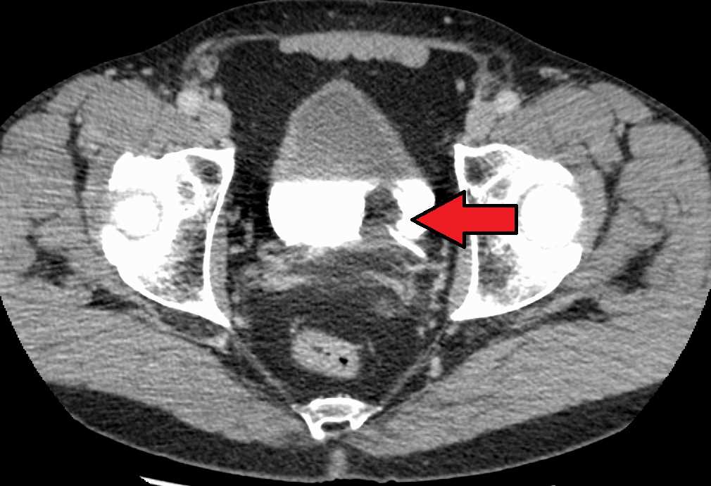 <p>Transitional Cell Carcinoma of the Bladder. The white area in the bladder is contrast.</p>