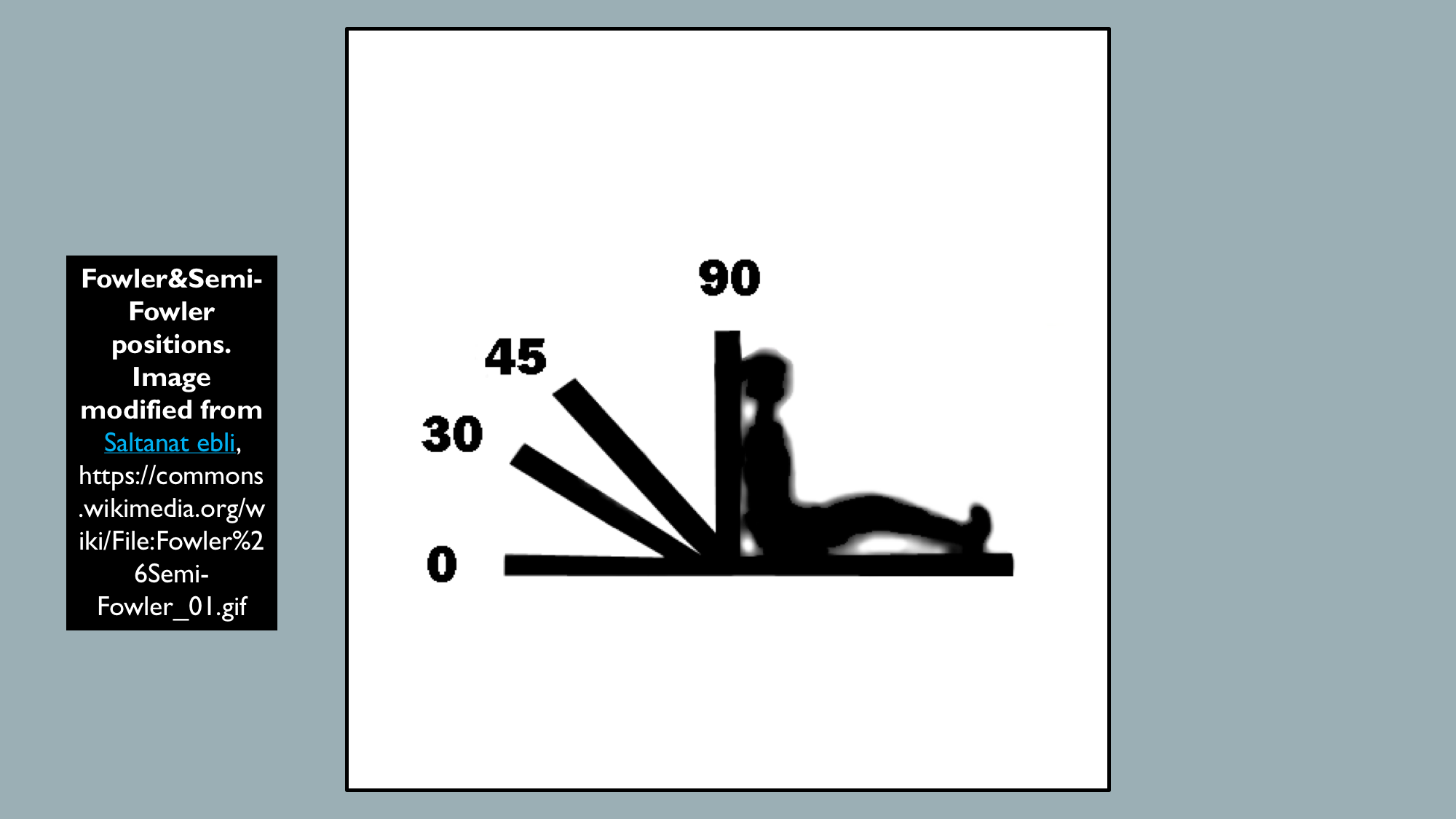 <p>Fowler and Semi-Fowler Positions