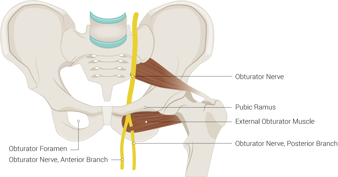 Obturator Foramen, Pubic Ramus, External Obturator Muscle, Obturator Nerve, Posterior Branch, Obturator Nerve, Anterior Branch