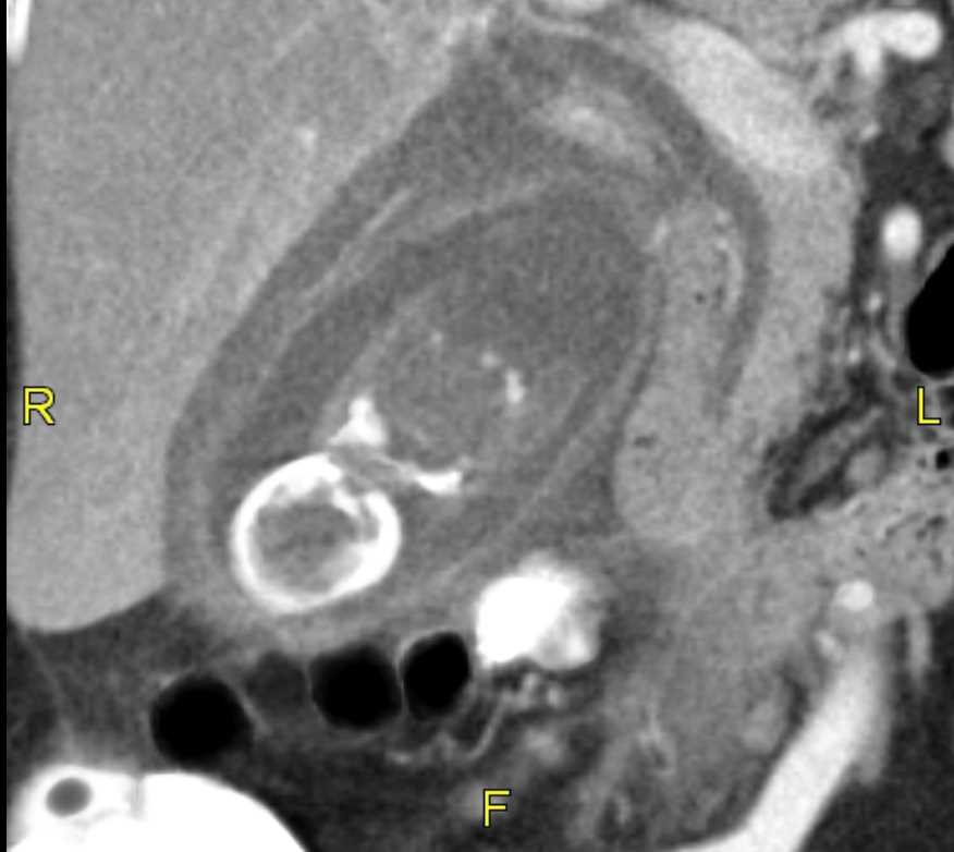Axial CT abdomen Acute cholecystitis