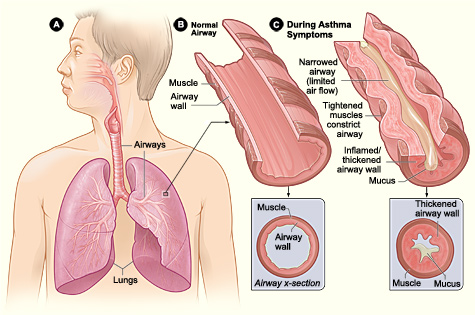 Figure A shows the location of the lungs and airways in the body. Figure B shows a cross-section of a normal airway. Figure C shows a cross-section of an airway during asthma symptoms
