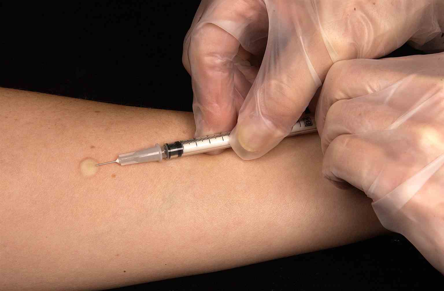 This technician is in the process of correctly placing a Mantoux tuberculin skin test in this recipient’s forearm, which will cause a 6mm to10mm wheal, i.e., a raised area of skin surface, to form at the injection site. The Mantoux tuberculin skin test is used to evaluate people for latent tuberculosis (TB) infection. In the United States, this skin test consists of an intradermal injection of exactly one tenth of a milliliter (mL) of tuberculin, which contains five tuberculin units. Correct placement of this intradermal injection involves inserting the needle bevel slowly at a 5° to 15° angle. The needle bevel is advanced through the epidermis, the superficial layer of skin, approximately 3mm so that the entire bevel is covered and lies just under the skin surface. A tense, pale wheal that is 6mm to 10mm in diameter appears over the needle bevel.