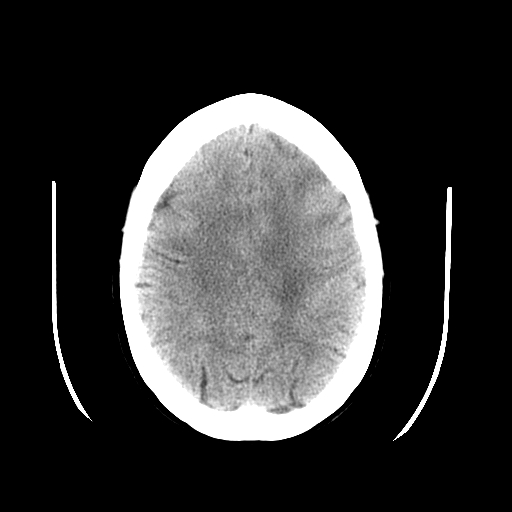 <p>CT Brain Artifact</p>