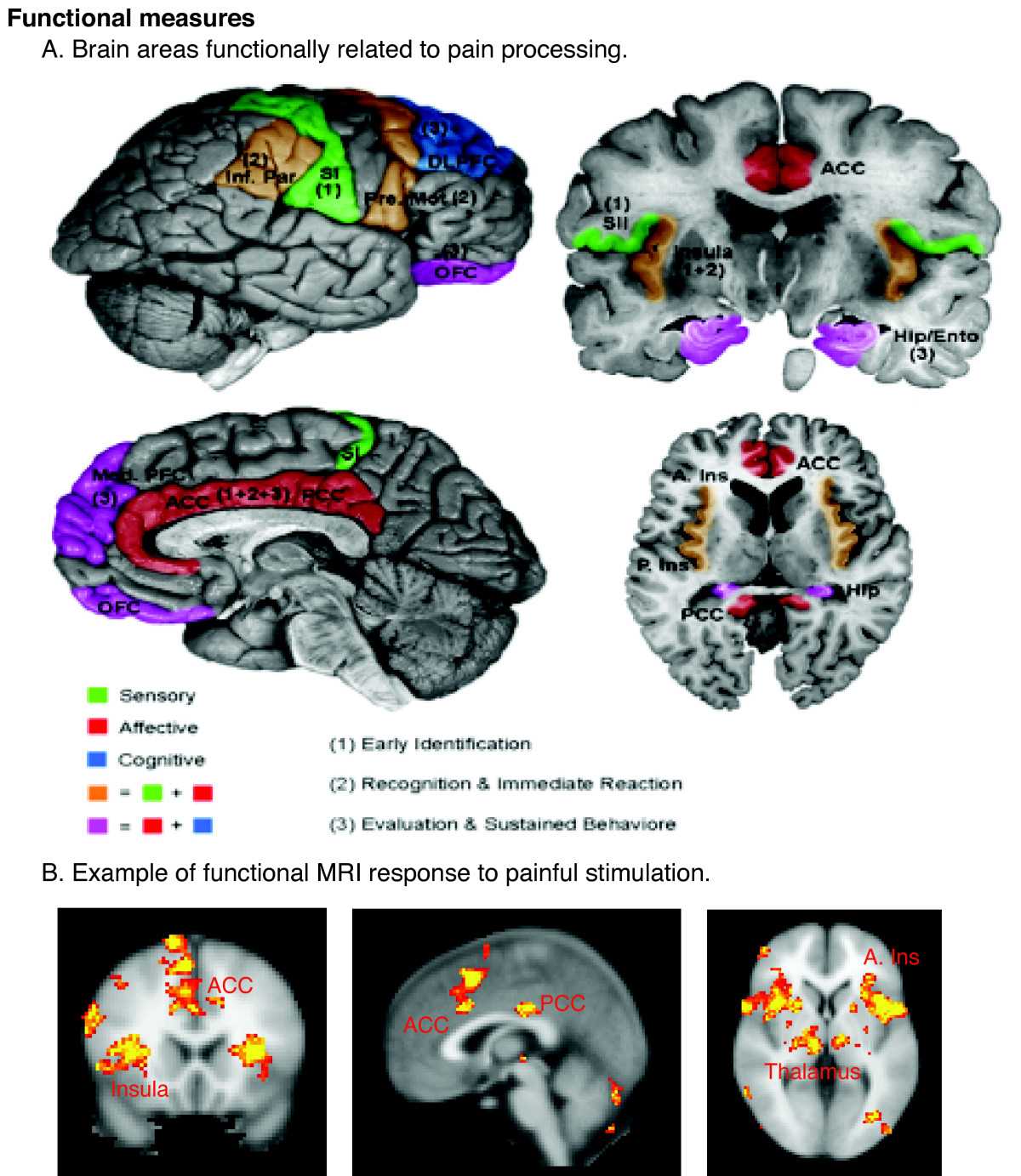 
Regions of the cerebral cortex associated with pain.
Neuroimaging revolutionizes therapeutic approaches to chronic pain