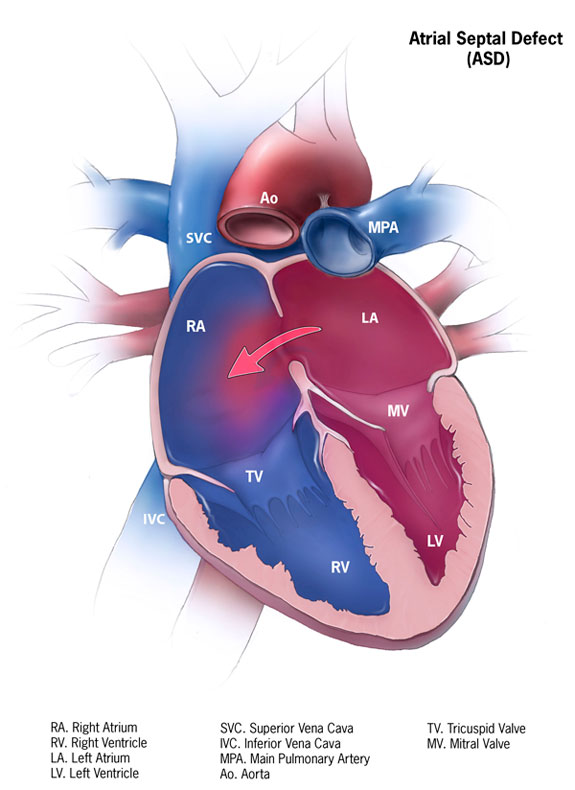 Atrial septal defect, next to a normal heart