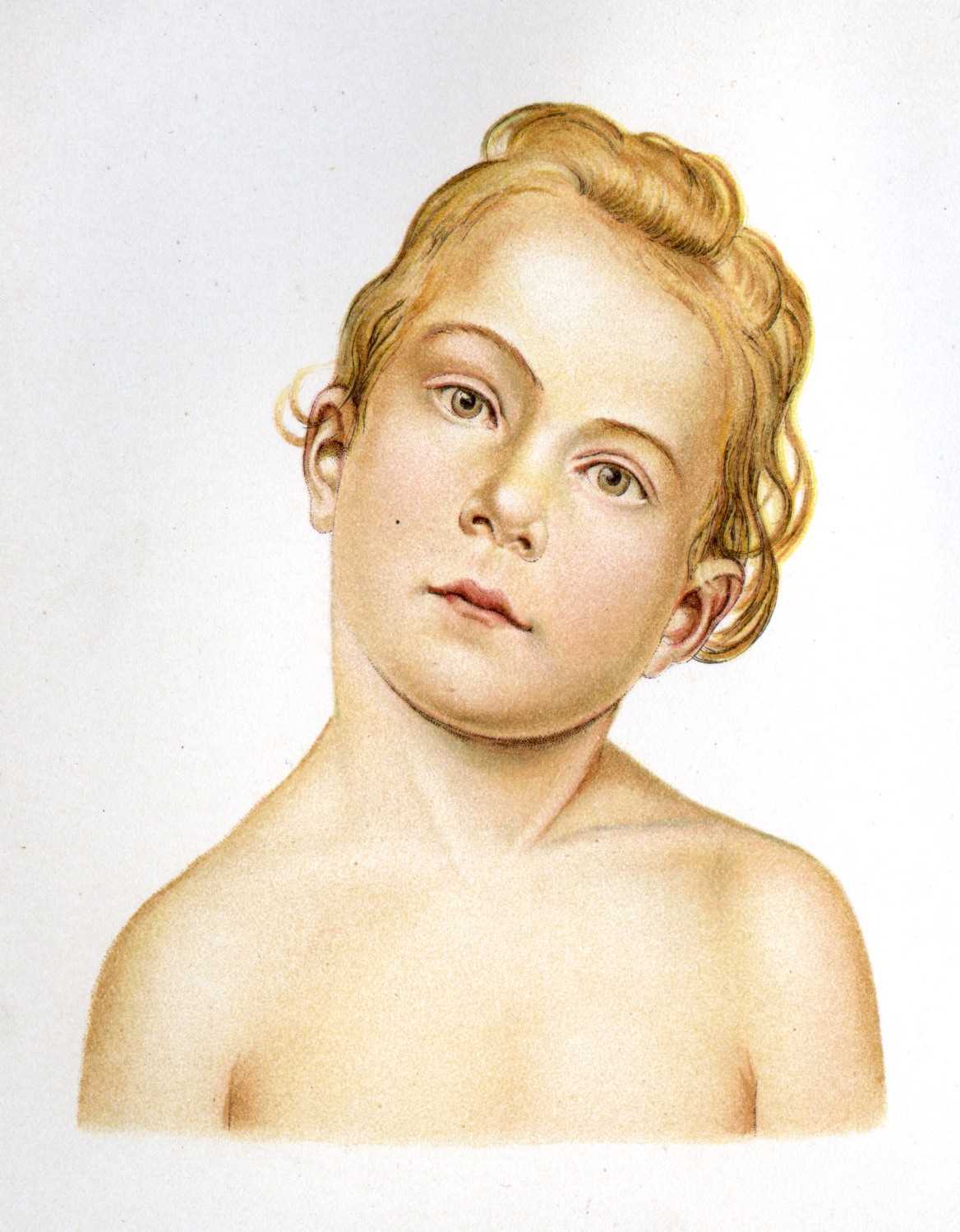 A child with Torticollis