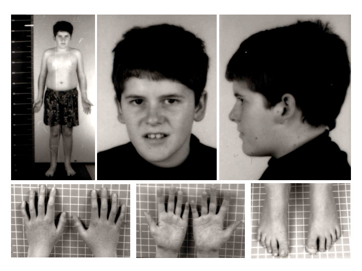 Prader-Willi syndrome phenotype at 15 years of age
