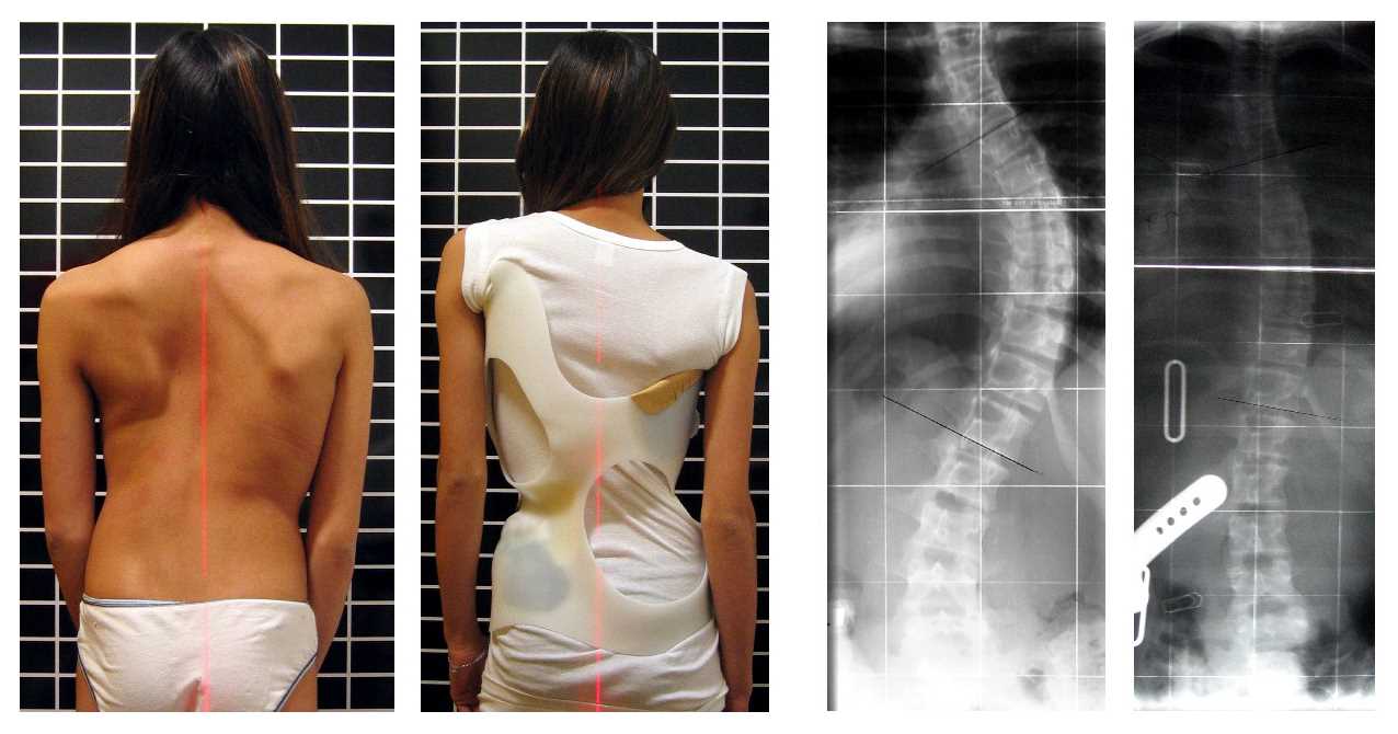Scoliosis patient in Chêneau brace correcting from 56° to 27° Cobb (primary correction of 52%).