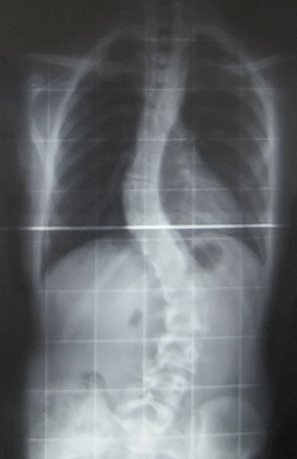 This is an posterior-to-anterior X-ray of a case of adolescent idiopathic scoliosis - specifically, my spine. There is a thoracic curve of 30° and a lumbar curve of 53° (Cobb angle - see scoliosis).
This was taken at the Royal National Orthopaedic Hospital. The largest curve (53°) is of a magnitude typically near the lower surgery boundary, although many factors decide whether surgery is necessary on a scoliosis case.