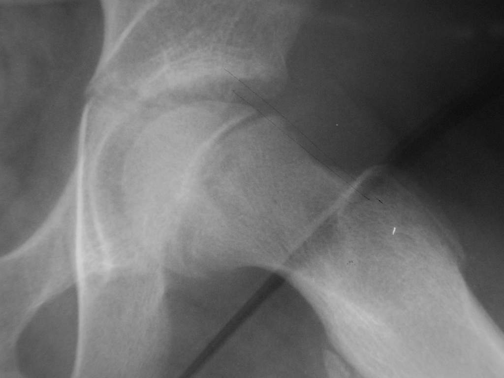 Slipped capital femoral epiphysis, radiogram