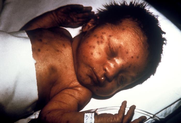  "This infant presented with 'blueberry muffin' skin lesions indicative of congenital rubella."