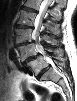 <p>Sagittal MRI of Lumbar Spine With Spondylolisthesis, L3-4 and L4-5.</p>