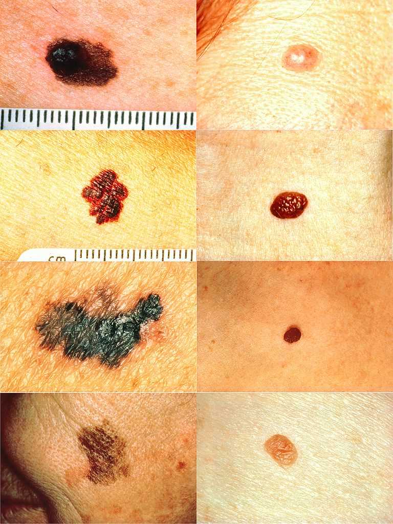  Part of the ABCDs for detection of melanoma. On the left side from top to bottom: melanomas showing (A) Asymmetry, (B) a border that is uneven, ragged, or notched, (C) coloring of different shades of brown, black, or tan and (D) diameter that had changed in size. The normal moles on the right side do not have abnormal characteristics (no asymmetry, even border, even color, no change in diameter).
