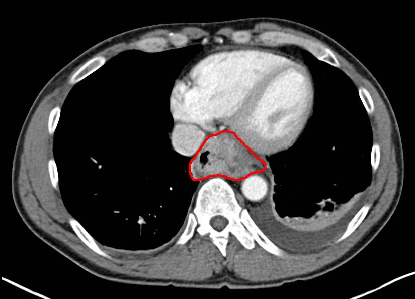 <p>Computed Tomography With Contrast