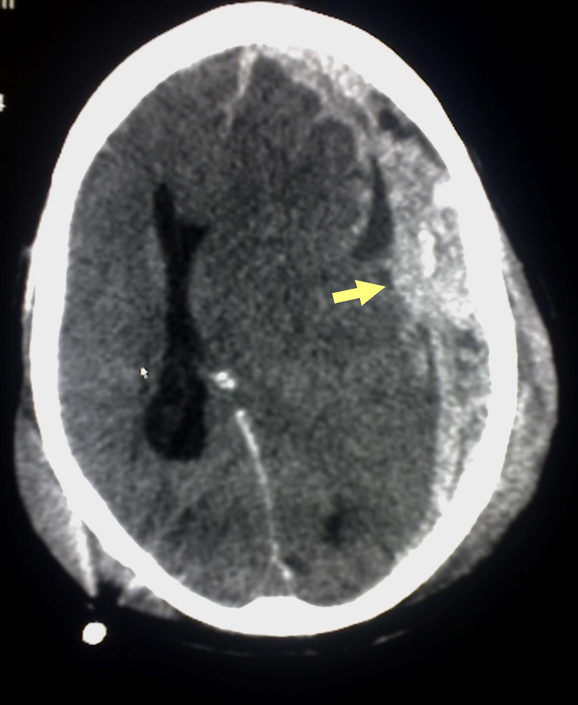 Abusive Head Trauma/Shaken Baby Syndrome/Subdural hematoma (arrow), bleeding between the dura mater of the meninges and the brain, commonly occurs in SBS/Abusive head trauma.