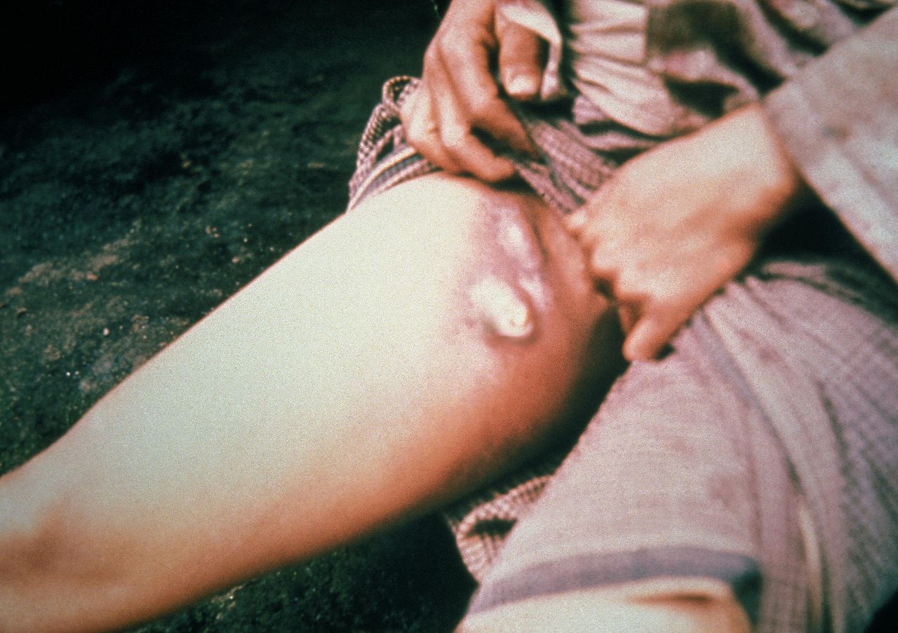 This plague patient is displaying a swollen, ruptured inguinal lymph node, or buboe. After the incubation period of 2-6 days, symptoms of the plague appear including severe malaise, headache, shaking chills, fever, and pain and swelling, or adenopathy, in the affected regional lymph nodes, also known as buboes.