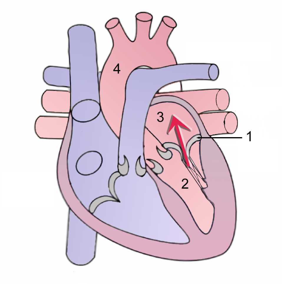 Mitral regurgitation/During systole, contraction of the left ventricle causes abnormal back flow (arrow) into the left atrium. (1)Mitral valve (2)Left Ventricle (3) Left Atrium (4)Aorta