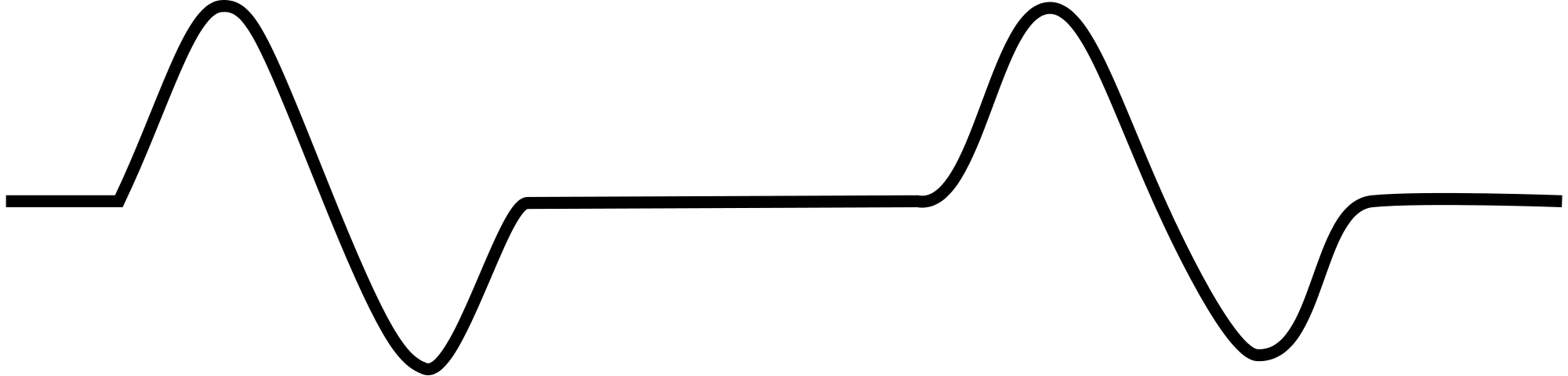 Pulseless electrical activity EKG