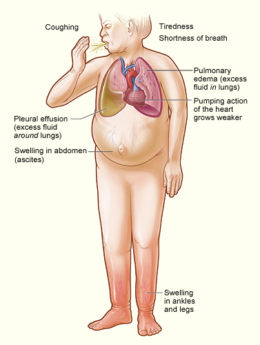  The illustration shows the major signs and symptoms of heart failure.