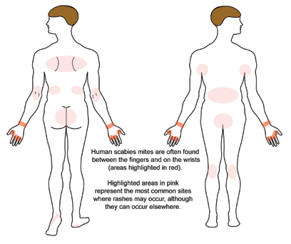 <p>Rash and Scabies Sites</p>