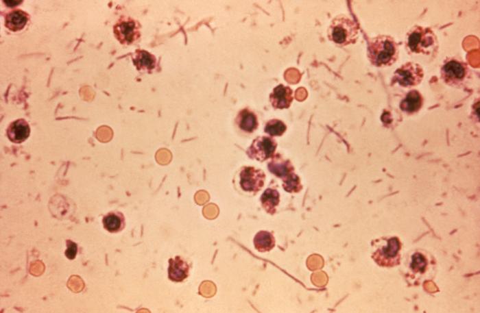 This photomicrograph revealed stool exudates in a patient with shigellosis, which is also known as “Shigella dysentery”, or “Bacterial dysentery”