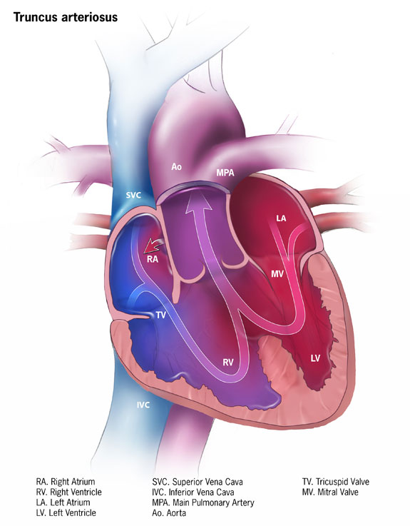 <p>Truncus Arteriosus Pathology