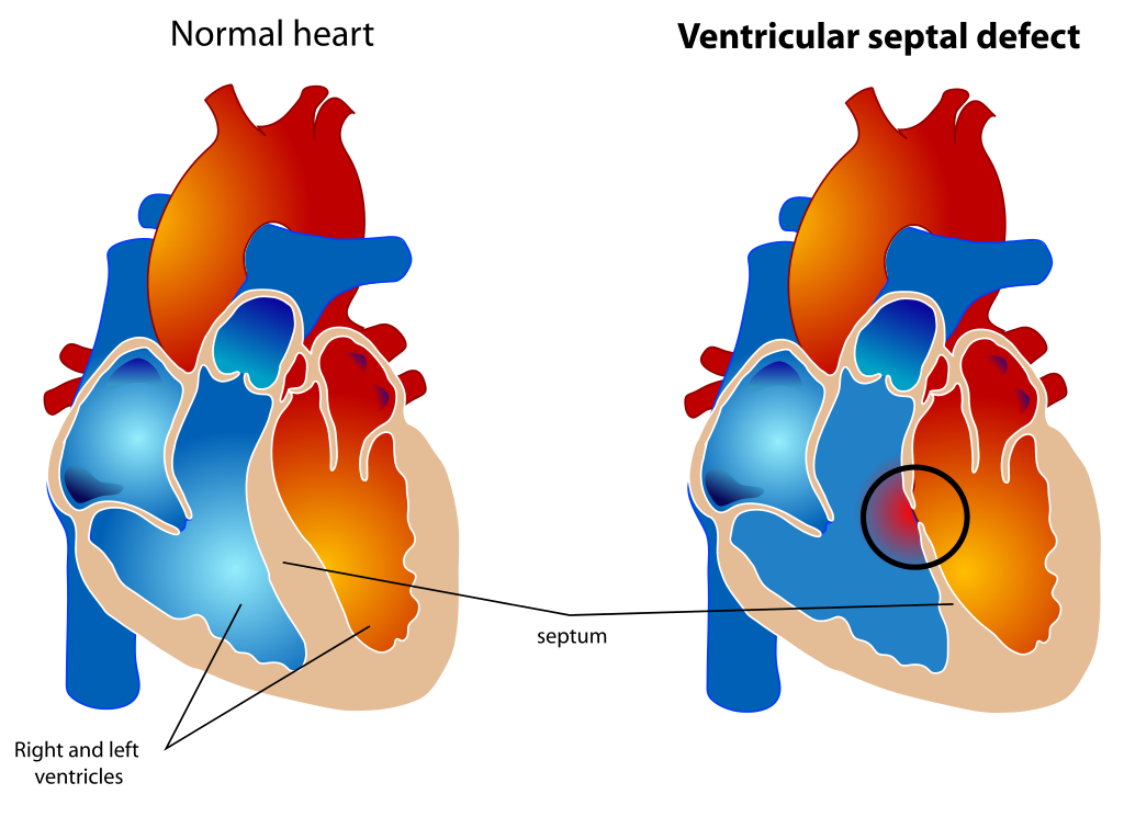 <p>Ventricular Septal Defect