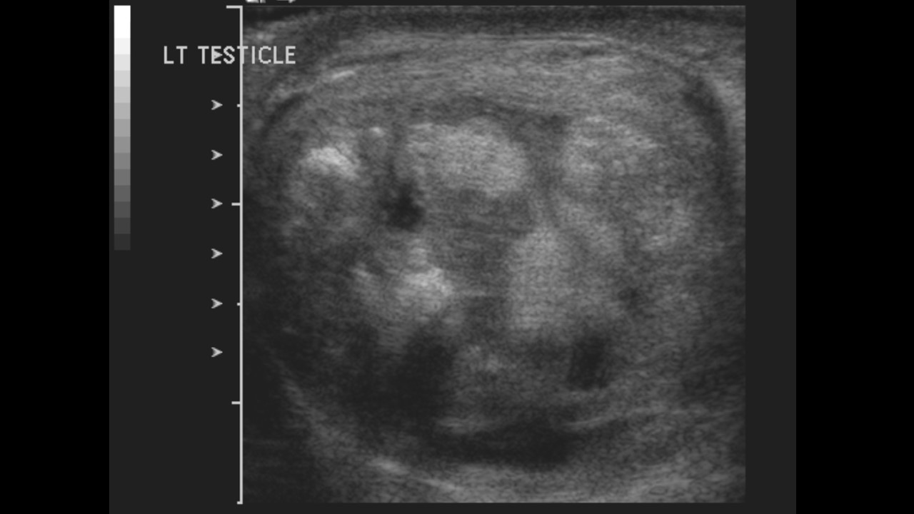 <p>Immature Teratoma With Focal Glangioneuroblastic Differentiation</p>