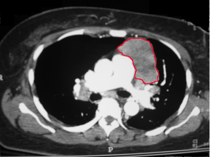 CT scan of the Chest, Necrotic Mass, Left Anterior Mediastinum, Histology, Thymoma.