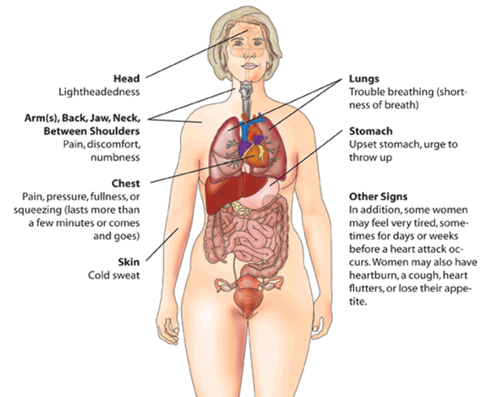 Heart attack (myocardial infarction) warning signs in women.