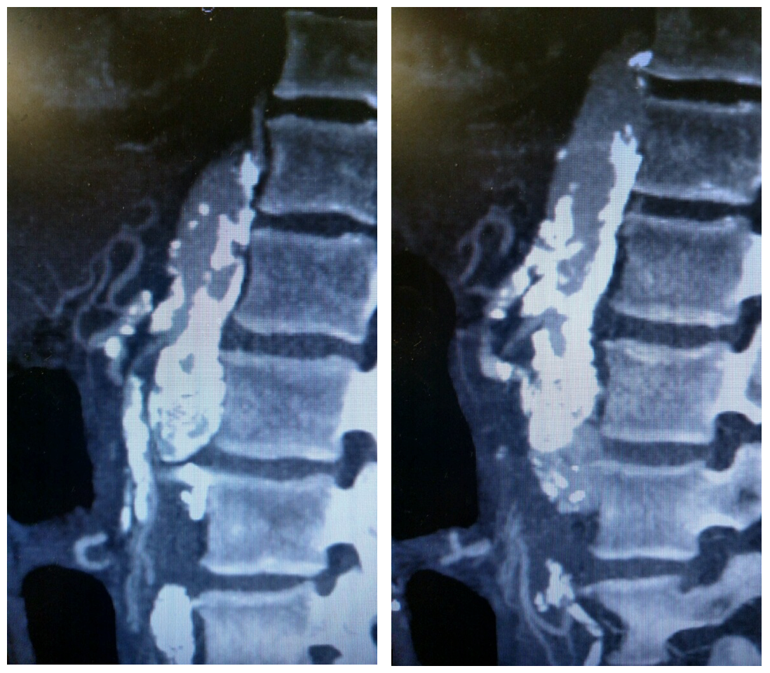 Sagittal view of CT angiogram showing severe atherosclerotic disease of the SMA and celiac artery. 
