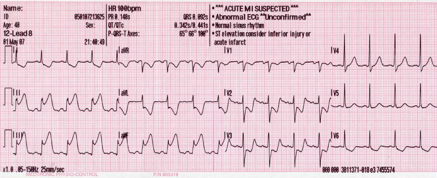 An ECG showing pardee waves indicating acute myocardial infarction in the inferior leads II, III and aVF with reciprocal changes in the anterolateral leads.
