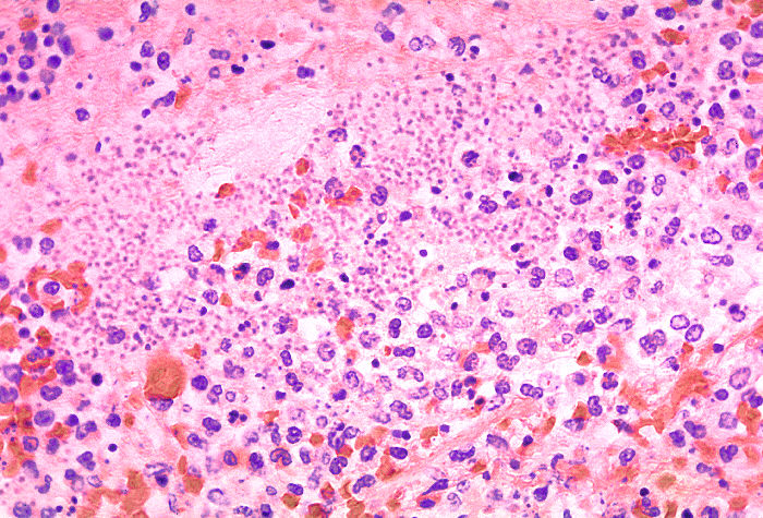 Histology, Section of Lung, Pneumonic