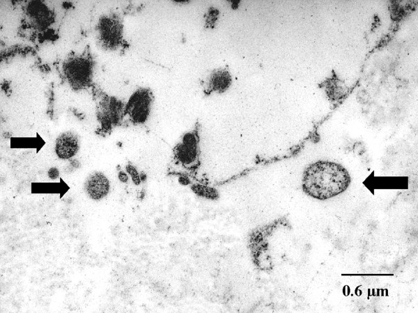 Transmission electron microscopy of alpha-1 antitrypsin deficiency emphysema, Chlamydial bodies shown by arrows, destruction of the interstitial connective tissue, Ultrastructure less well preserved after fixation of formaldehyde