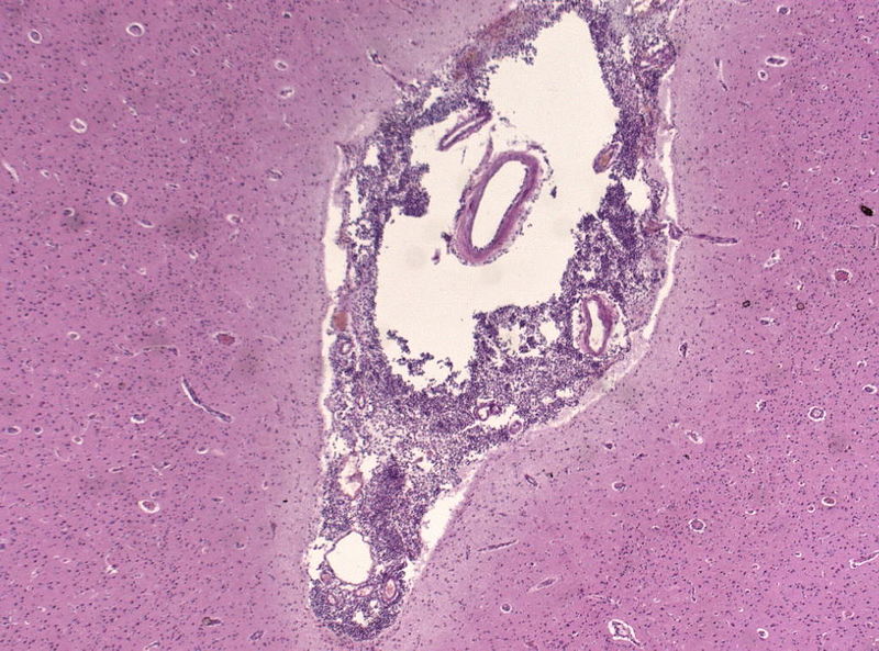 Neuropathology specimen, Purulent meningitis, HE Stain, Hematoxylin and Eosin stain