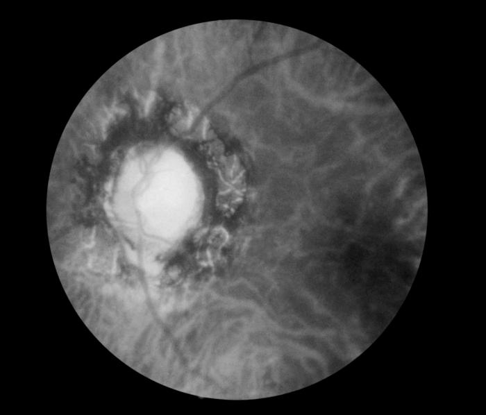 Fundoscopic image, effect of late neuro-ocular syphilis on the optic disk and retina, Pathology, Severe optic nerve atrophy, chorioretinitis, inflammation of the choroidal and neural layers of the retina