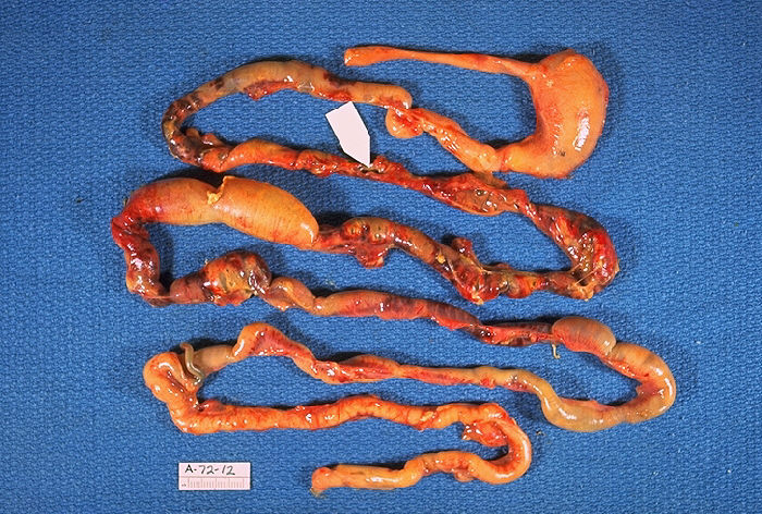 Gross Pathology, Neonatal, Necrotizing enterocolitis, Alimentary tract of infant, intestinal necrosis, pneumatosis intestinalis, perforation site shown by arrow