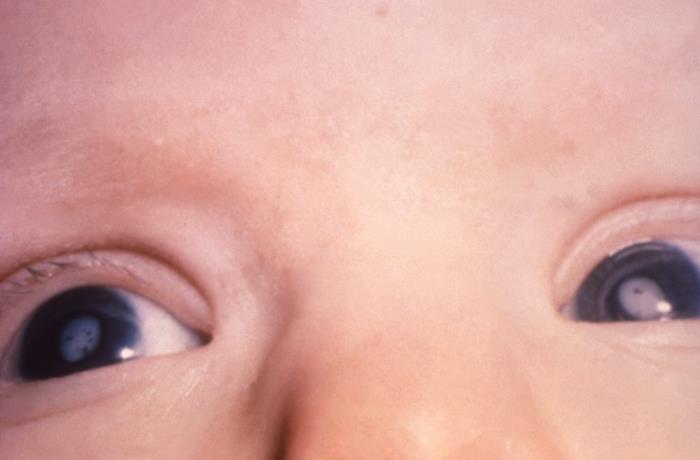 Cataracts, Child, Pathology, Congenital Rubella Syndrome, CRS
