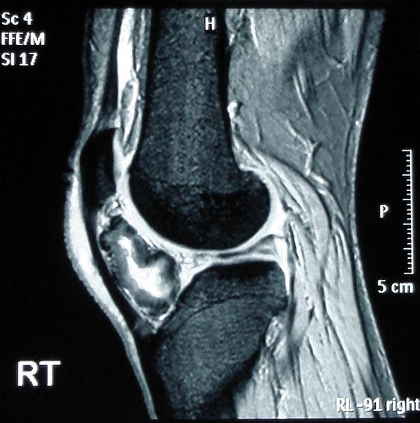 <p>Osteochondroma on MRI