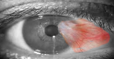 Pterygium, Eye, Conjunctiva, Ophthalmology, growing into the cornea, Palpebral fissure