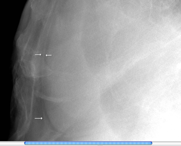 Chest Anatomy, Pericardial Stripe, Lateral view, X-ray