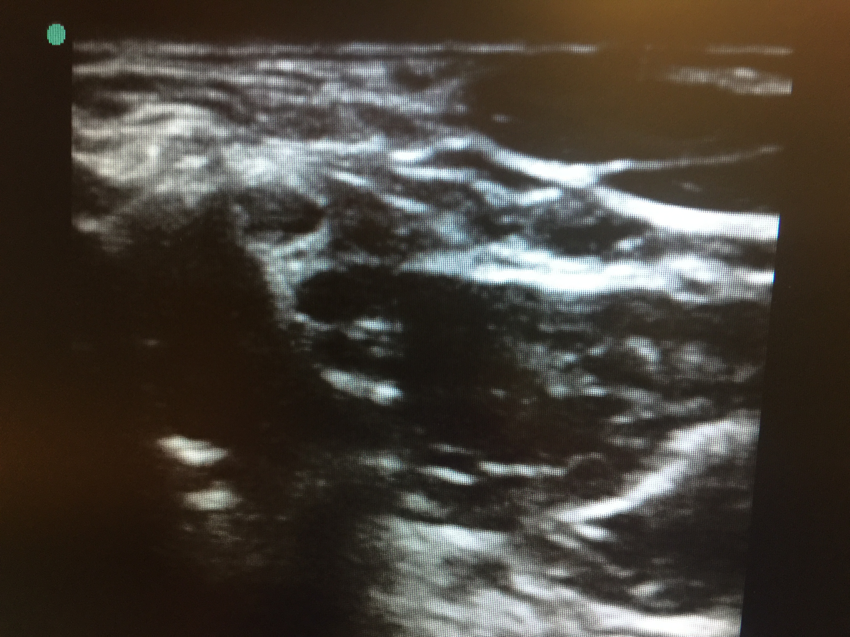 <p>Interscalene Nerve "Stoplight" Sign